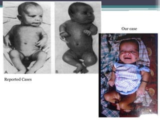 Reported Cases
Our case
 