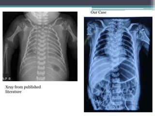 Xray from published
literature
Our Case
 