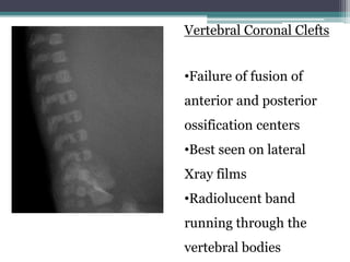 Vertebral Coronal Clefts
•Failure of fusion of
anterior and posterior
ossification centers
•Best seen on lateral
Xray films
•Radiolucent band
running through the
vertebral bodies
 