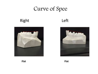 Curve of Spee
Right Left
Flat Flat
 