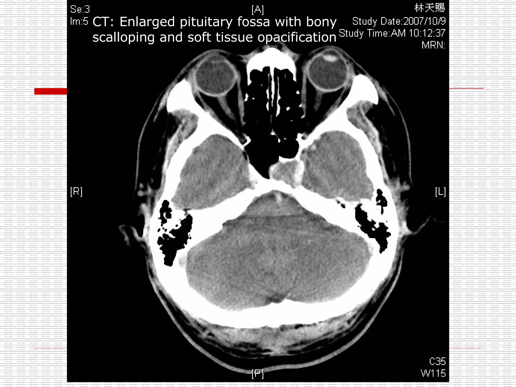 CT: Enlarged pituitary fossa with bony scalloping and soft tissue opacification 