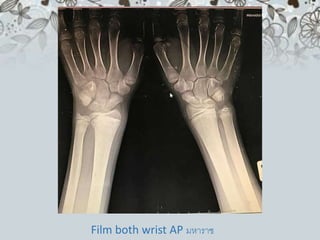 Film both wrist AP มหาราช
 