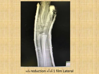 หลัง reduction ครั้งที่ 1 film Lateral
 