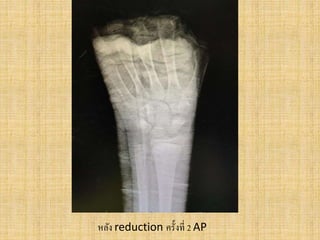 หลัง reduction ครั้งที่ 2 AP
 
