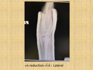 หลัง reduction ครั้งที่ 2 Lateral
 