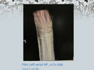 Film Left wrist AP ,หลังใส่ slab
ก่อนทาการผ่าตัด
 