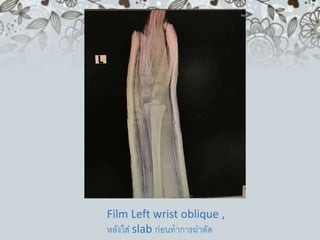 Film Left wrist oblique ,
หลังใส่ slab ก่อนทาการผ่าตัด
 