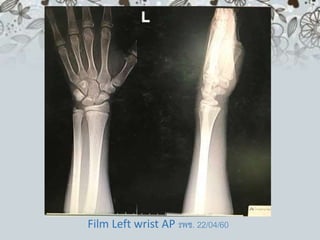 Film Left wrist AP รพช. 22/04/60
 