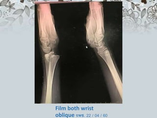 Film both wrist
oblique รพช. 22 / 04 / 60
 