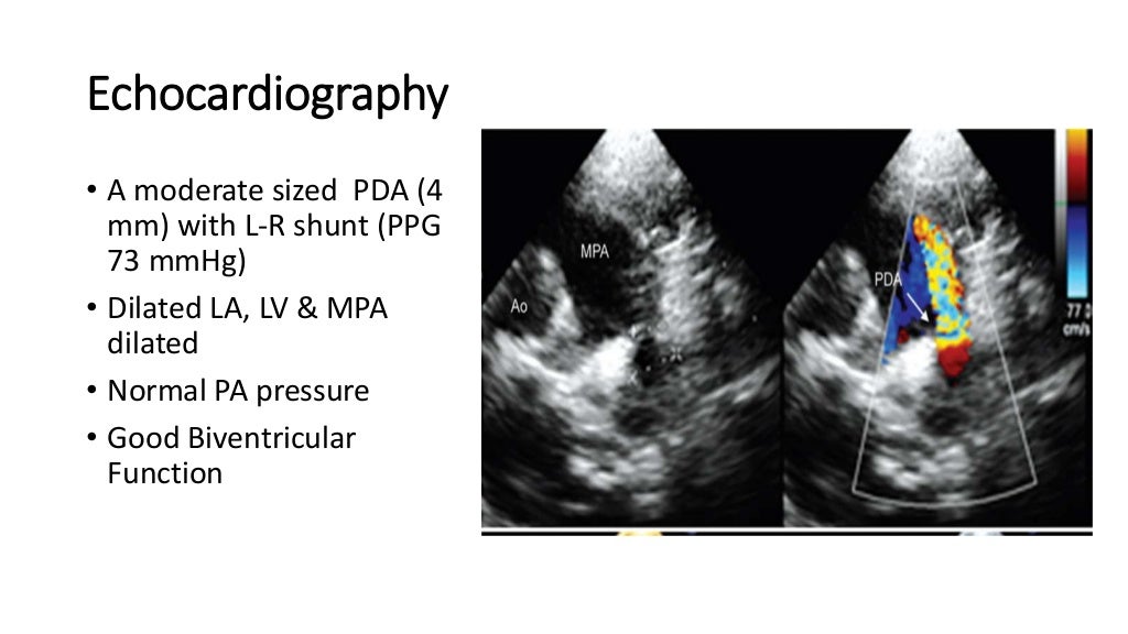 Case presentation on PDA