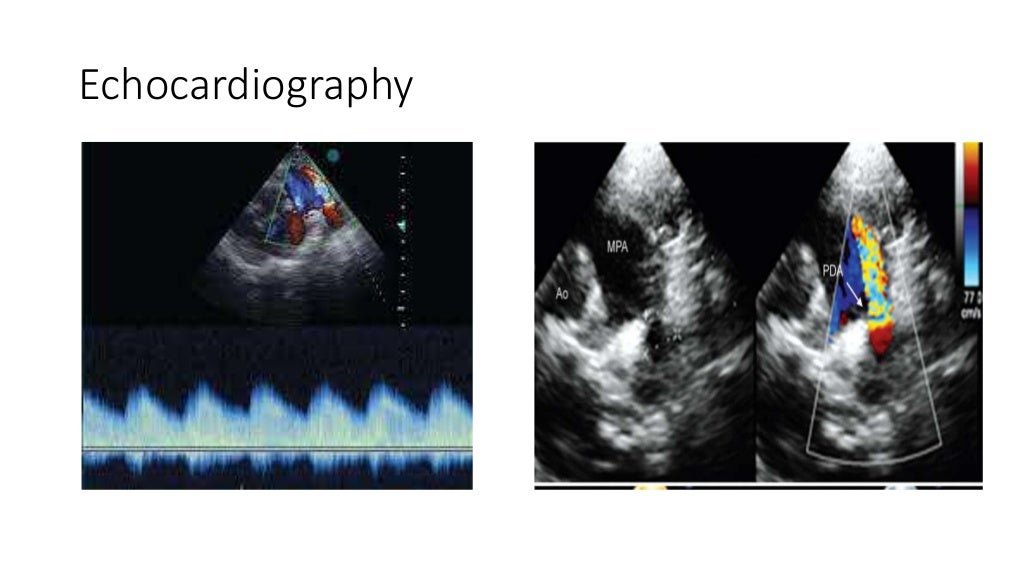 Case presentation on PDA