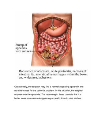 Occasionally, the surgeon may find a normal-appearing appendix and
no other cause for the patient's problem. In this situation, the surgeon
may remove the appendix. The reasoning in these cases is that it is
better to remove a normal-appearing appendix than to miss and not
 