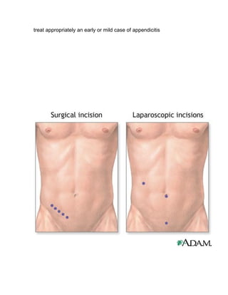 treat appropriately an early or mild case of appendicitis
 