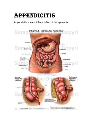 APPENDICITIS
Appendicitis means inflammation of the appendix
 