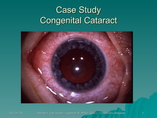 Case Study Congenital Cataract 