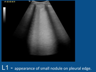 L1 - appearance of small nodule on pleural edge.
 