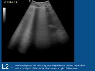 L2 - note cartilaginous ribs indicating that the probe was close to the midline,
with a small part of the cardiac shadow to the right of the screen.
 