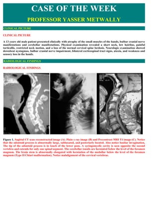 CASE OF THE WEEK
                   PROFESSOR YASSER METWALLY
CLINICAL PICTURE

CLINICAL PICTURE

A 13 years old male patient presented clinically with atrophy of the small muscles of the hands, bulbar cranial nerve
manifestations and cerebellar manifestations. Physical examination revealed a short neck, low hairline, painful
torticollis, restricted neck motion, and a loss of the normal cervical spine lordosis. Neurologic examination showed
downbeat nystagmus, bulbar cranial nerve impairment, bilateral corticospinal tract signs, ataxia, and weakness and
sensory loss in the hands.

RADIOLOGICAL FINDINGS

RADIOLOGICAL FINDINGS  




Figure 1. Sagittal CT scan reconstructed image (A). Plain x ray image (B) and Precontrast MRI T1 image (C). Notice
that the odontoid process is abnormally large, subluxated, and posteriorly located. Also notice basilar invagination,
The tip of the odontoid process is in touch of the lower pons. A syringomyelic cavity is seen opposite the second
vertebra and extends for only one spinal segment. The cerebellar tonsils are herniated below the level of the foramen
magnum. The brain stem is abnormally elongated with herniation of the medullar below the level of the foramen
magnum (Type II Chiari malformation). Notice malalignment of the cervical vertebrae.
 