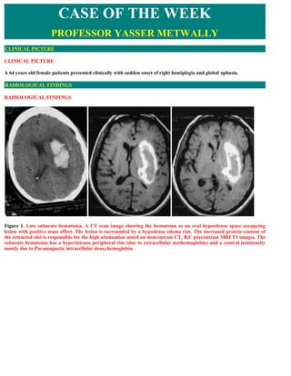 CASE OF THE WEEK
                     PROFESSOR YASSER METWALLY
CLINICAL PICTURE

CLINICAL PICTURE

A 64 years old female patients presented clinically with sudden onset of right hemiplegia and global aphasia.

RADIOLOGICAL FINDINGS

RADIOLOGICAL FINDINGS  




Figure 1. Late subacute hematoma. A CT scan image showing the hematoma as an oval hyperdense space occupying
lesion with positive mass effect. The lesion is surrounded by a hypodense edema rim. The increased protein content of
the retracted clot is responsible for the high attenuation noted on noncontrast CT. B,C precontrast MRI T1 images. The
subacute hematoma has a hyperintense peripheral rim (due to extracellular methemoglobin) and a central isointensity
mostly due to Paramagnetic intracellular deoxyhemoglobin.
 