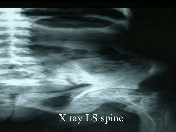 A Case of Paget's Disease