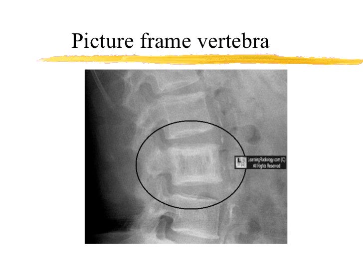 A Case Of Paget s Disease A Case Of Paget s Disease
