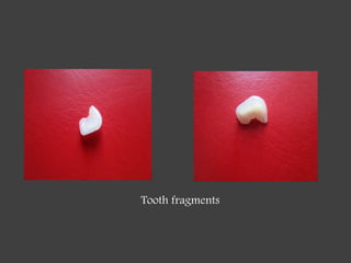 Fragmented Tooth Reattachment | PPTX