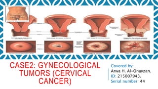 CASE2: GYNECOLOGICAL
TUMORS (CERVICAL
CANCER)
Covered by:
Arwa H. Al-Onayzan.
ID: 215007943.
Serial number: 44
 