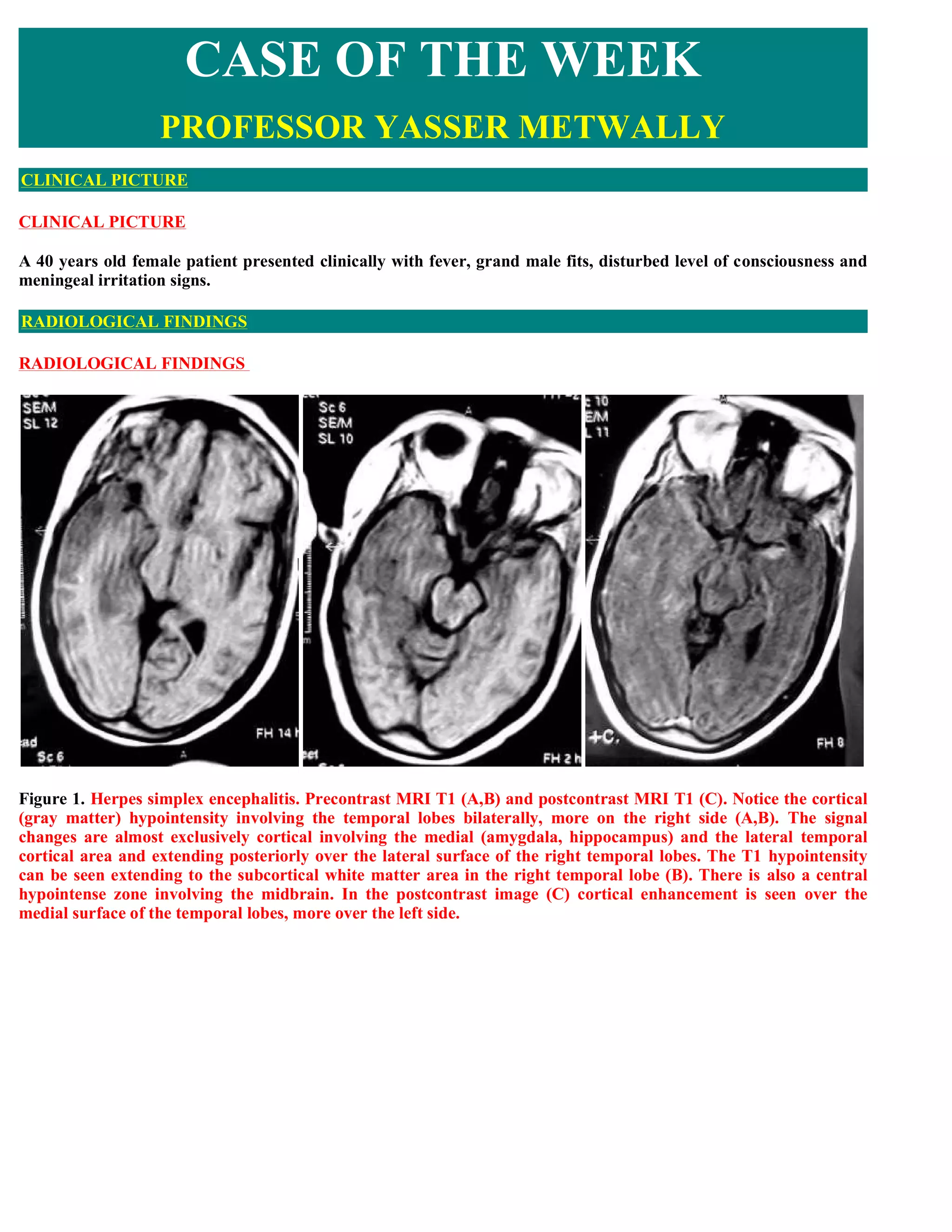 Case record...Herpes simplex encephalitis | PDF
