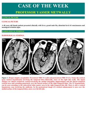 CASE OF THE WEEK
                   PROFESSOR YASSER METWALLY
CLINICAL PICTURE

CLINICAL PICTURE

A 40 years old female patient presented clinically with fever, grand male fits, disturbed level of consciousness and
meningeal irritation signs.

RADIOLOGICAL FINDINGS

RADIOLOGICAL FINDINGS  




Figure 1. Herpes simplex encephalitis. Precontrast MRI T1 (A,B) and postcontrast MRI T1 (C). Notice the cortical
(gray matter) hypointensity involving the temporal lobes bilaterally, more on the right side (A,B). The signal
changes are almost exclusively cortical involving the medial (amygdala, hippocampus) and the lateral temporal
cortical area and extending posteriorly over the lateral surface of the right temporal lobes. The T1 hypointensity
can be seen extending to the subcortical white matter area in the right temporal lobe (B). There is also a central
hypointense zone involving the midbrain. In the postcontrast image (C) cortical enhancement is seen over the
medial surface of the temporal lobes, more over the left side.
 