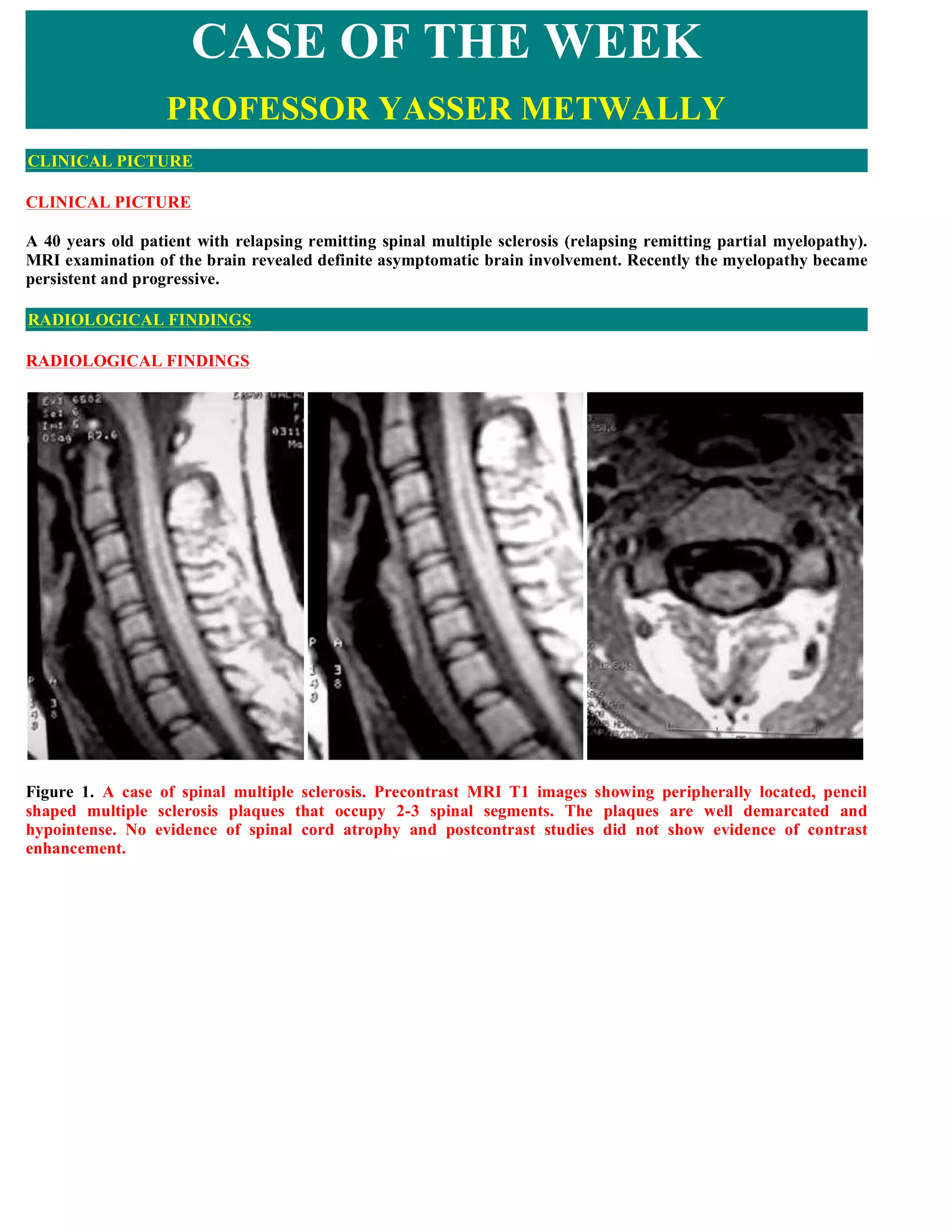 Case record...Spinal multiple sclerosis