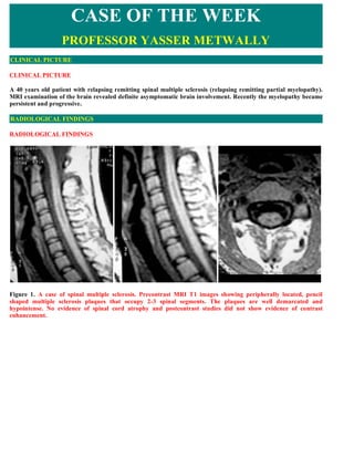 CASE OF THE WEEK
                   PROFESSOR YASSER METWALLY
CLINICAL PICTURE

CLINICAL PICTURE

A 40 years old patient with relapsing remitting spinal multiple sclerosis (relapsing remitting partial myelopathy).
MRI examination of the brain revealed definite asymptomatic brain involvement. Recently the myelopathy became
persistent and progressive.

RADIOLOGICAL FINDINGS

RADIOLOGICAL FINDINGS




Figure 1. A case of spinal multiple sclerosis. Precontrast MRI T1 images showing peripherally located, pencil
shaped multiple sclerosis plaques that occupy 2-3 spinal segments. The plaques are well demarcated and
hypointense. No evidence of spinal cord atrophy and postcontrast studies did not show evidence of contrast
enhancement.
 
