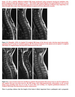 Case record...Spinal multiple sclerosis