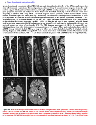 Case record...Spinal multiple sclerosis