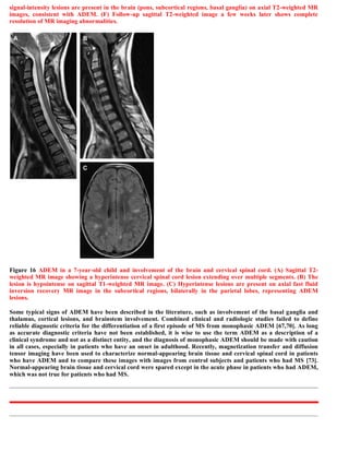 Case record...Spinal multiple sclerosis