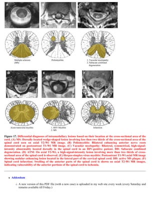 Case record...Spinal multiple sclerosis