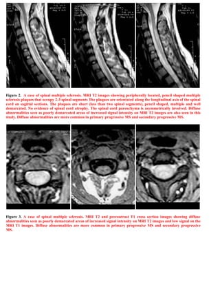 Case record...Spinal multiple sclerosis