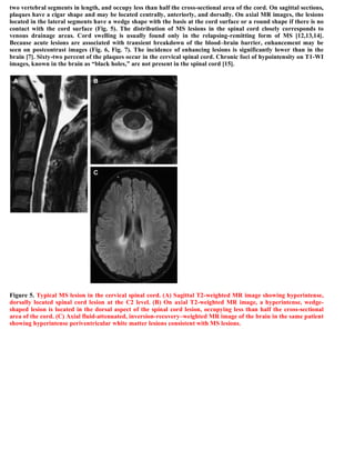 Case record...Spinal multiple sclerosis