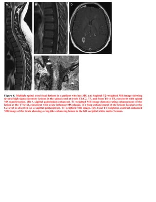 Case record...Spinal multiple sclerosis