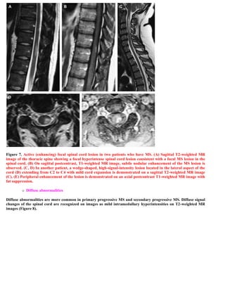 Case record...Spinal multiple sclerosis