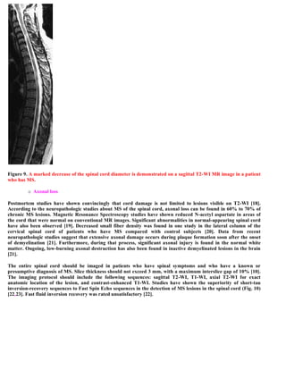 Case record...Spinal multiple sclerosis
