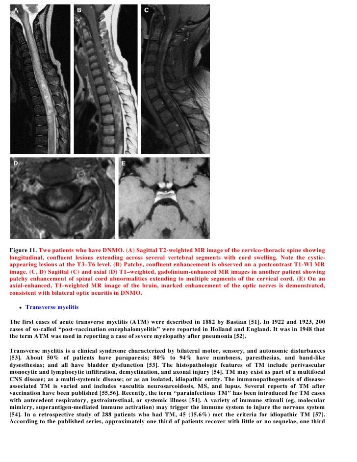 multiple sclerosis case study multiple sclerosis case study