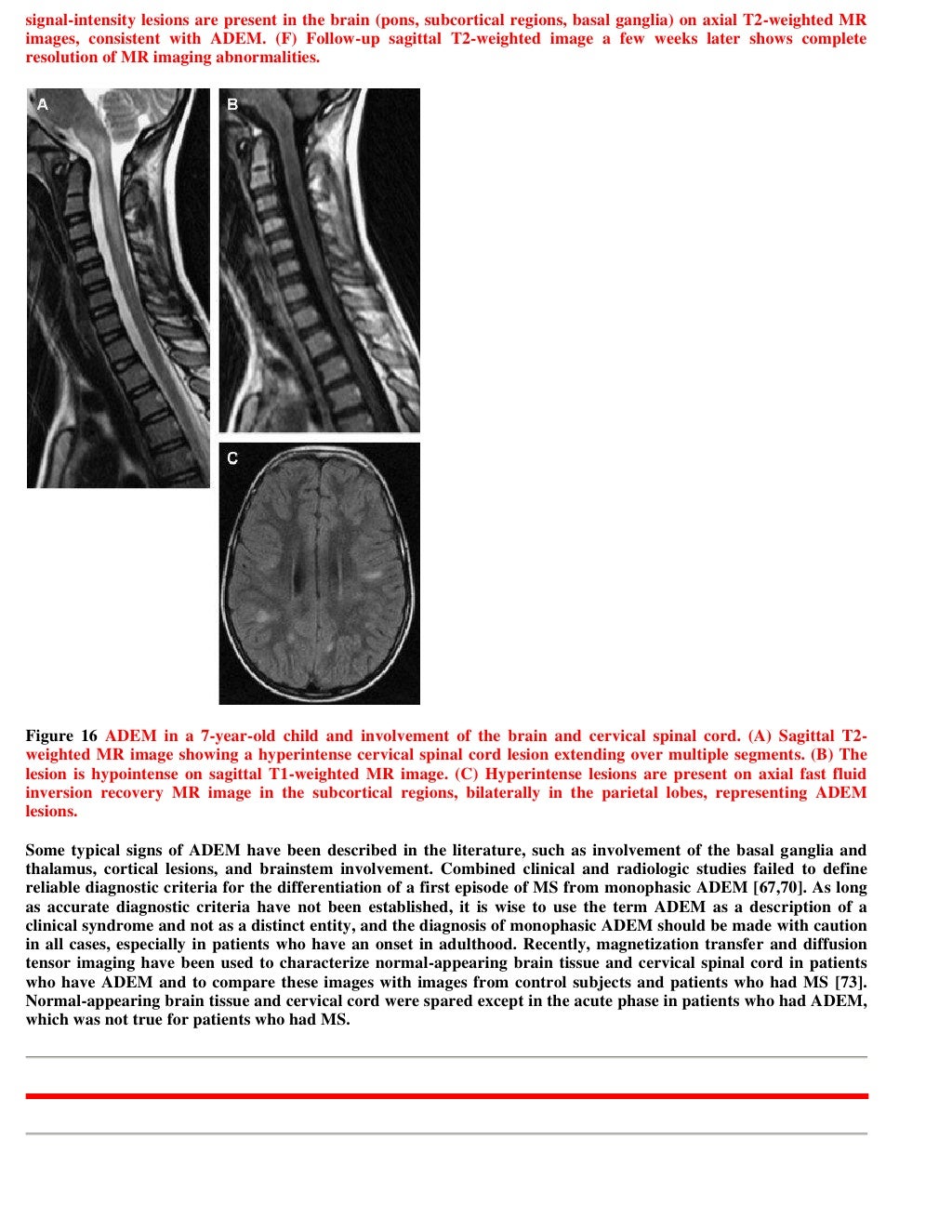 Case record...Spinal multiple sclerosis