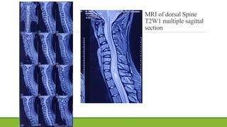 MRI of dorsal Spine
T2W1 multiple sagittal
section
 