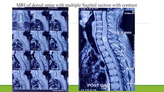 MRI of dorsal spine with multiple Sagittal section with contrast
 