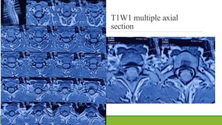 T1W1 multiple axial
section
 