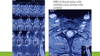 MRI of dorsal spine with
multiple axial section with
contrast
 