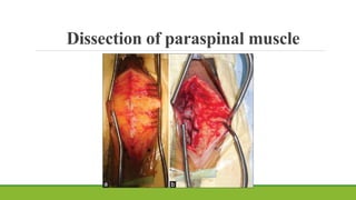 Dissection of paraspinal muscle
 
