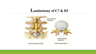 Laminotomy of C7 & D1
 