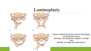 Laminoplasty
Various methods commonly used for laminoplasty.
(a) Single-door suture
technique. (b) Double-door allograft. (c) Single
door
allograft. (d) Single-door plate fixation.
 