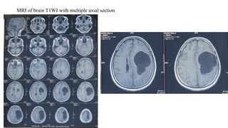 MRI of brain T1WI with multiple axial section
 